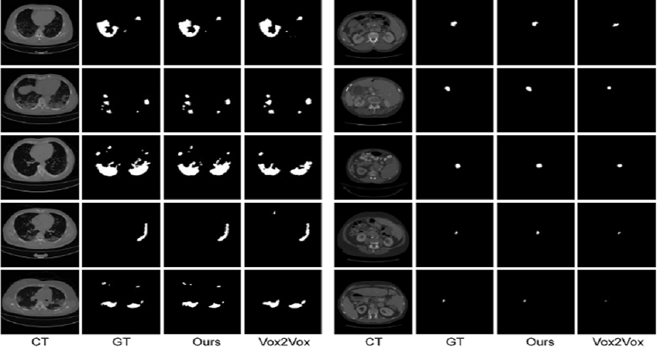 肝脏肿瘤 CT 图像分割方法研究 效果展示 2